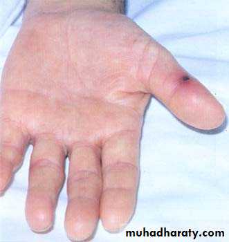 Infective endocarditis