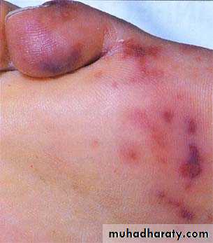 Infective endocarditis