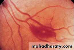 Infective endocarditis