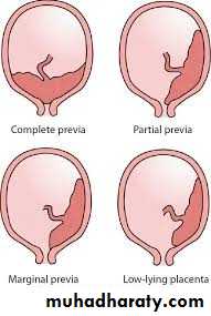Placenta previa