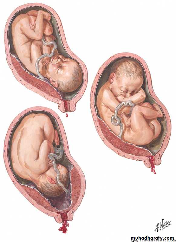 Placenta previa