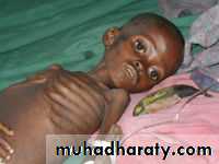 Malnutrition