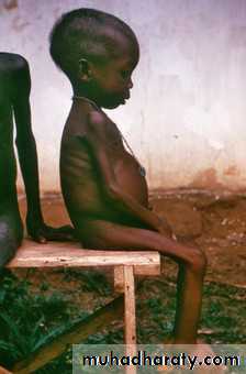 Malnutrition