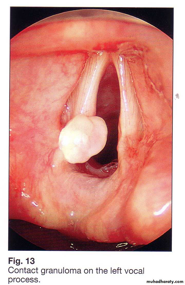 Congenital Abnormalities of Larynx
