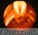 Congenital Abnormalities of Larynx