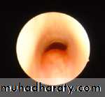 Congenital Abnormalities of Larynx