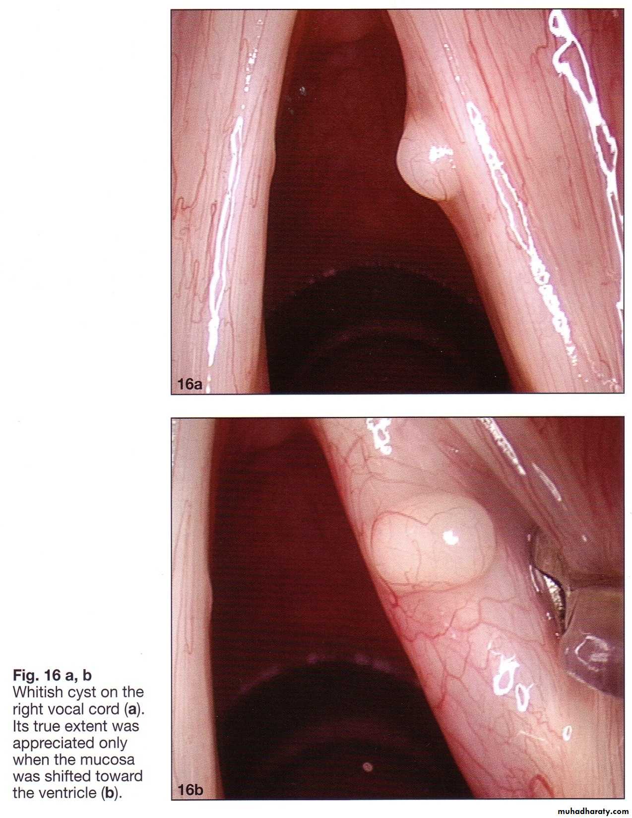 Congenital Abnormalities of Larynx