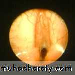 Congenital Abnormalities of Larynx