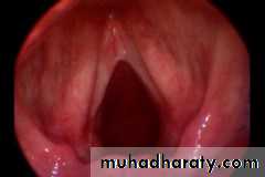 Congenital Abnormalities of Larynx