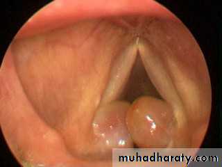Congenital Abnormalities of Larynx