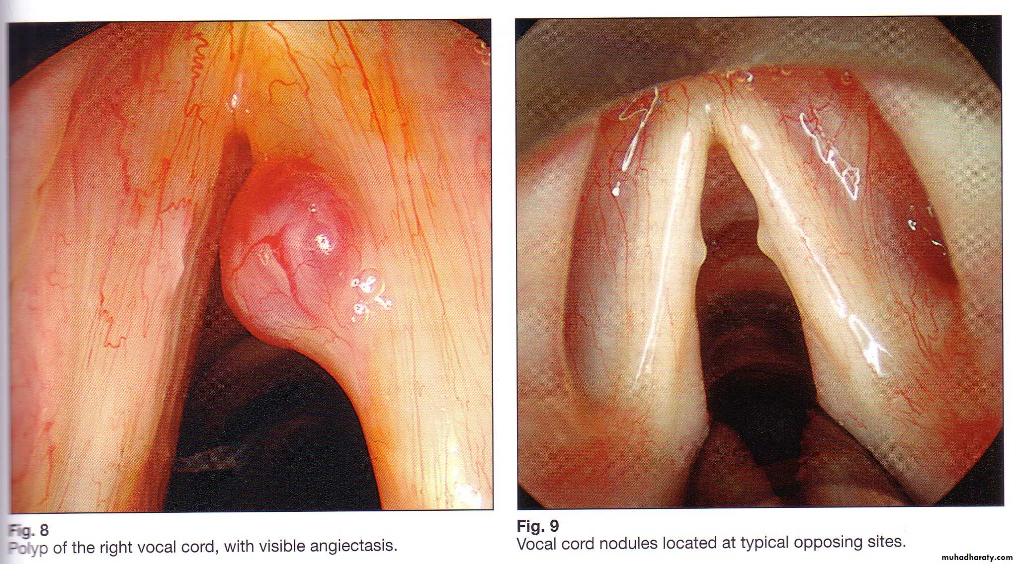 Congenital Abnormalities of Larynx
