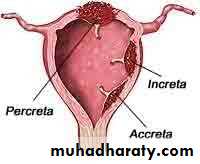 Placenta accreta