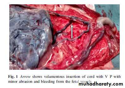 Placenta accreta