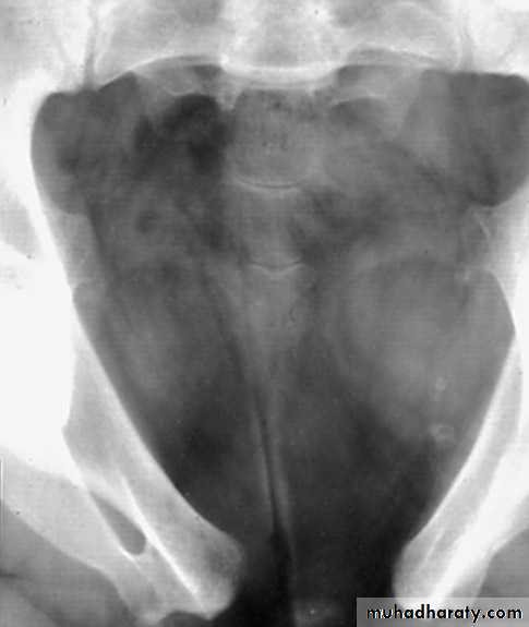 Disorders of the urinary bladder