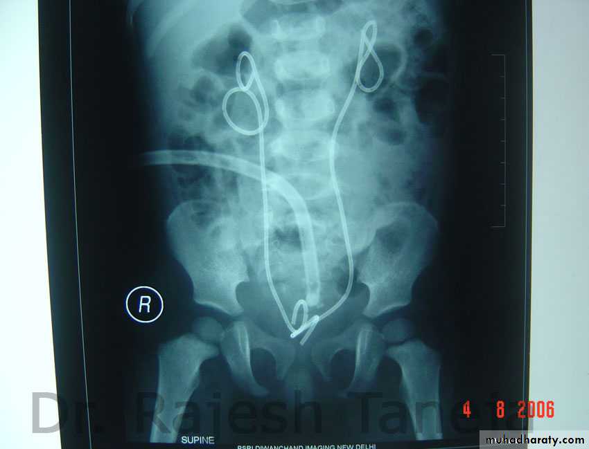 Disorders of the urinary bladder