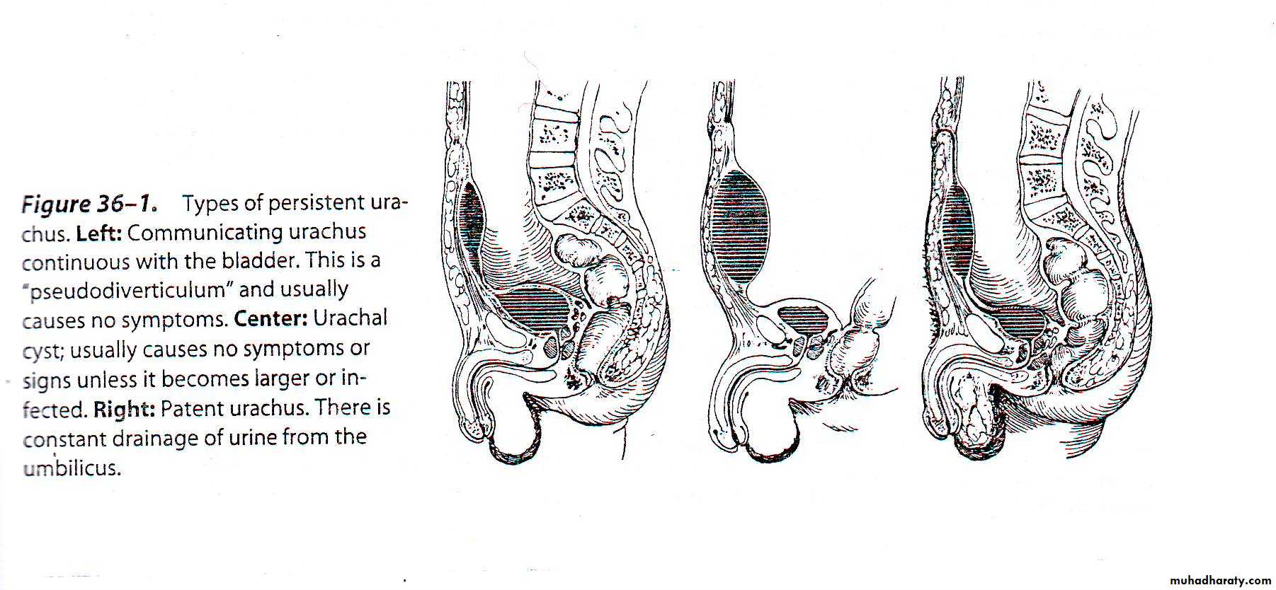 Disorders of the urinary bladder
