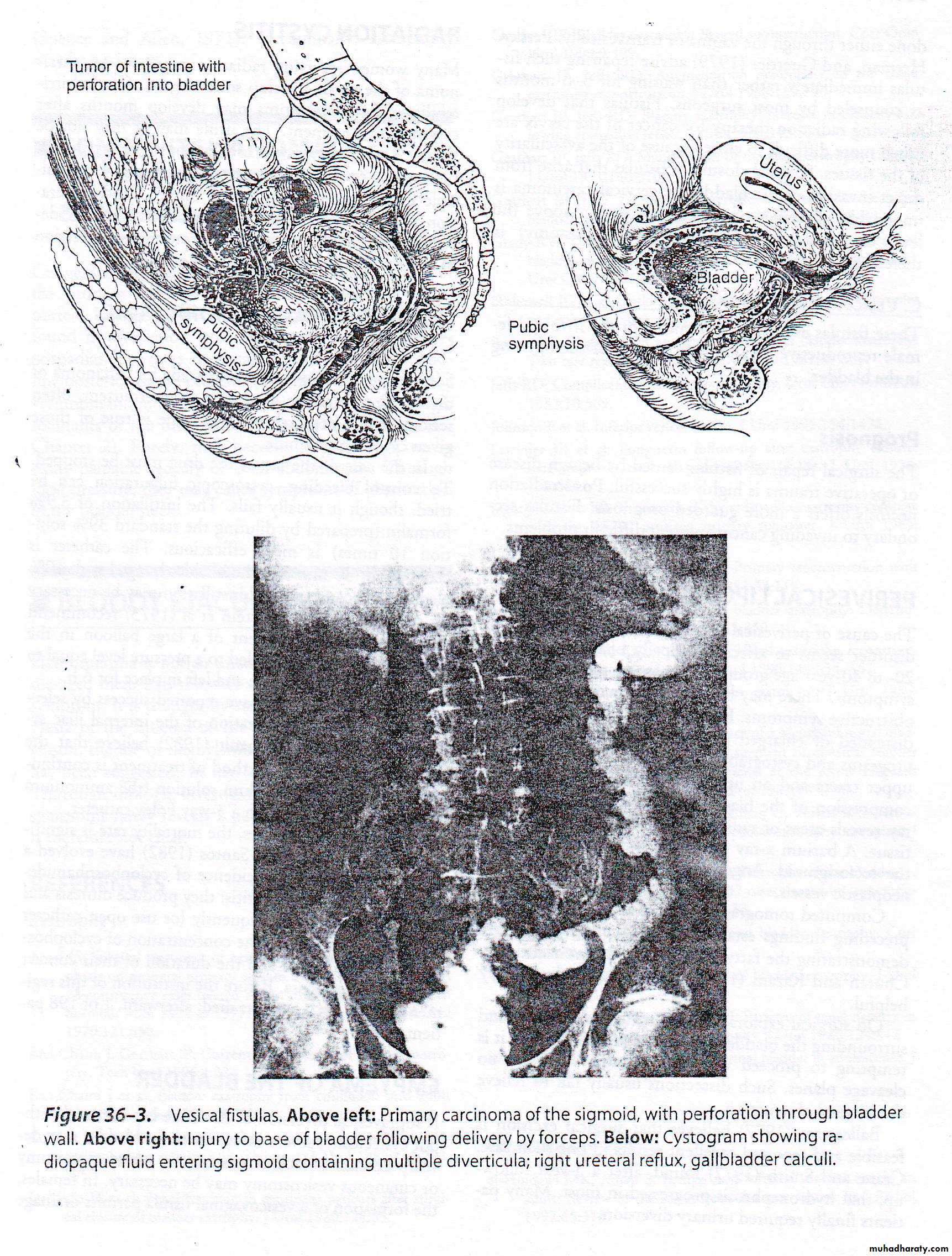 Disorders of the urinary bladder
