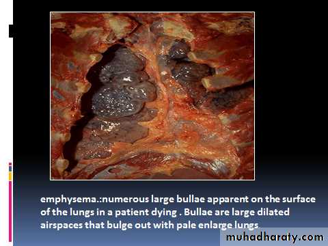 COPD 2