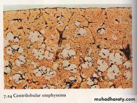 COPD 2