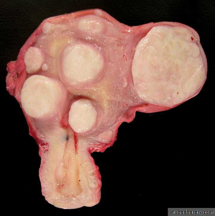 Uterus