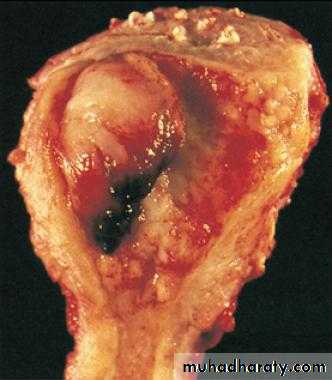 Uterus