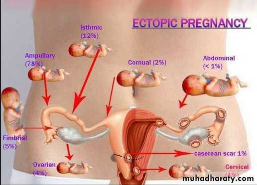 Fallopian Tubes