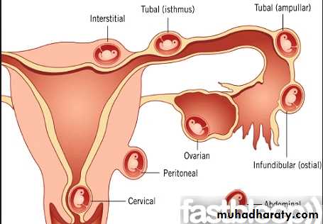 Fallopian Tubes