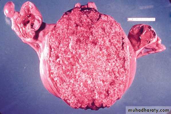 Fallopian Tubes