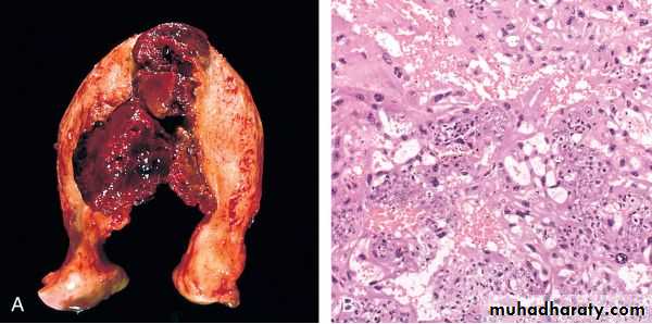 Fallopian Tubes
