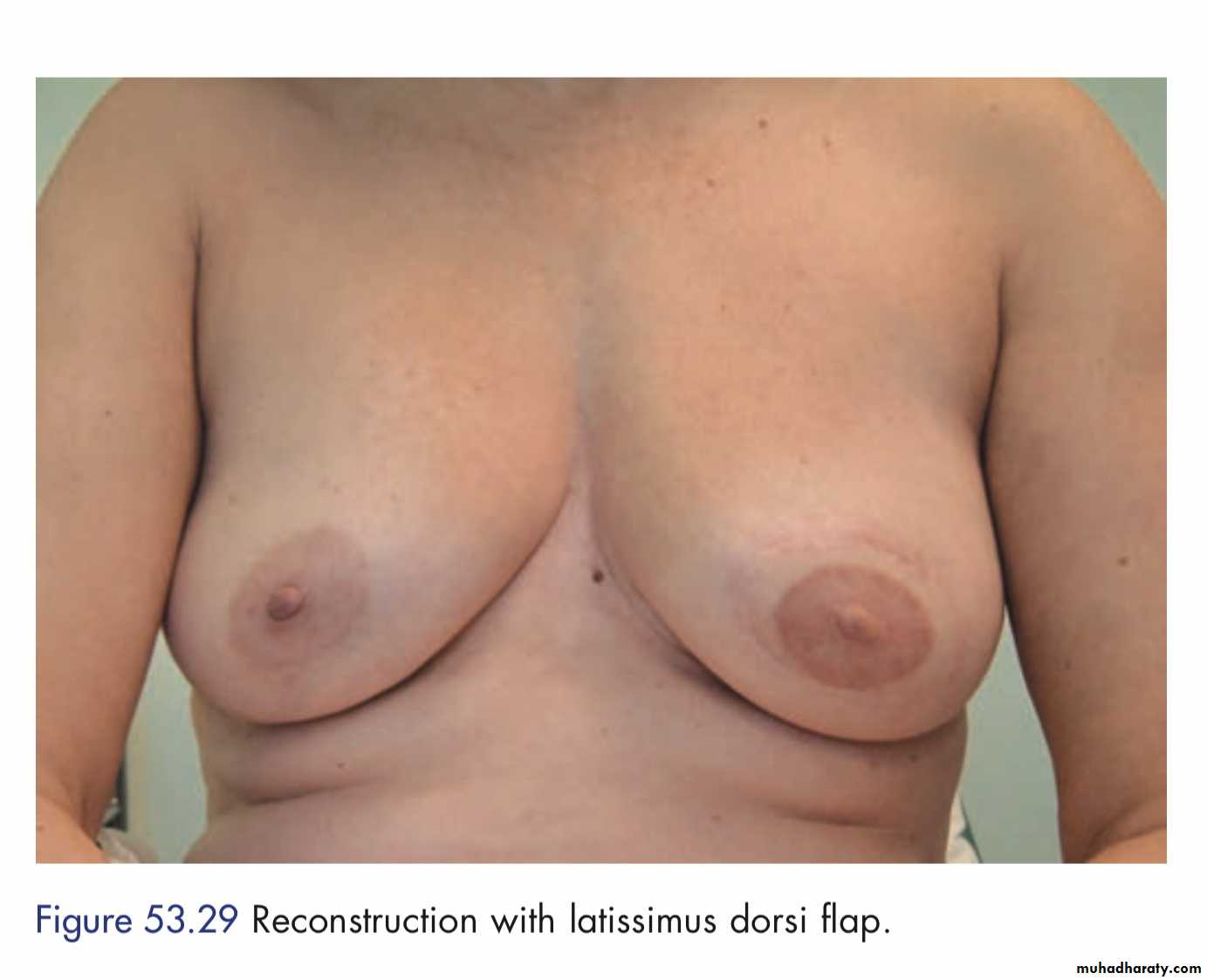 Breast