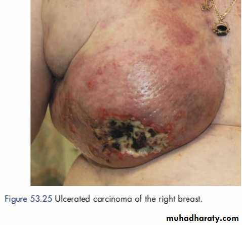 Breast