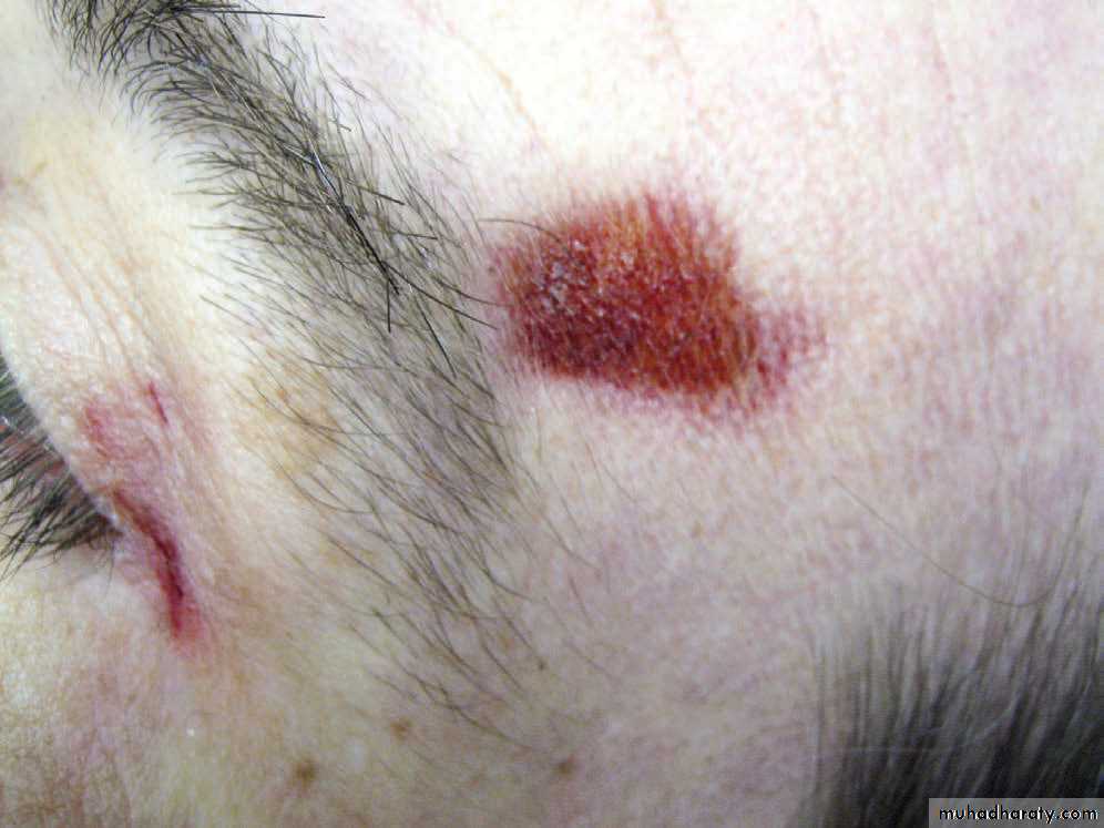 Wounds
