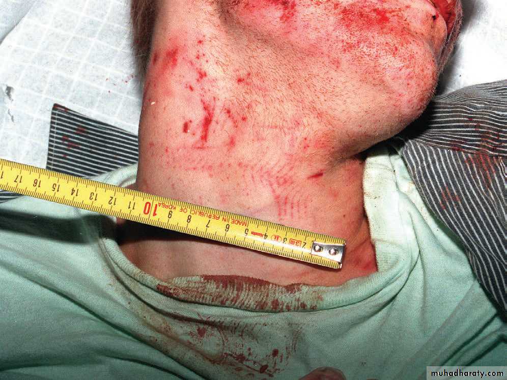 Wounds