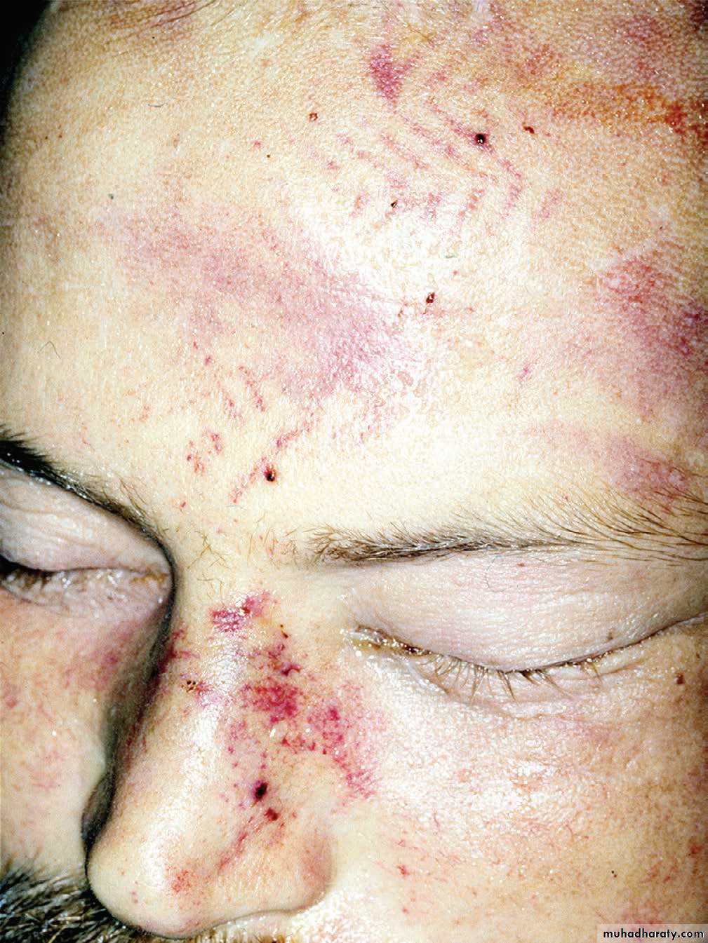 Wounds
