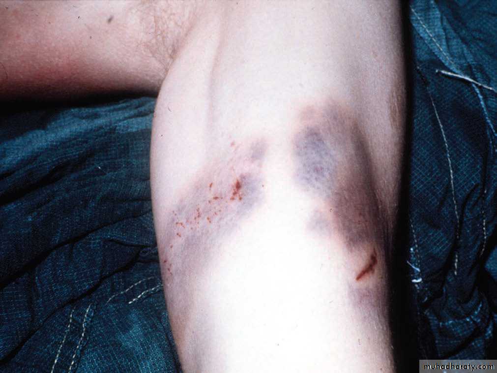 Wounds