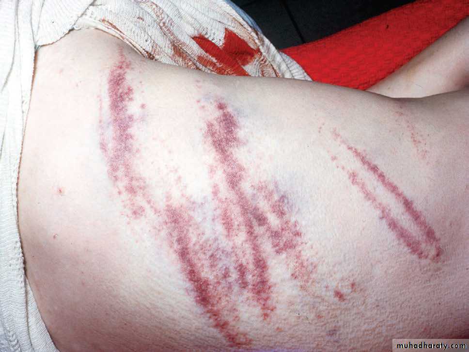 Wounds