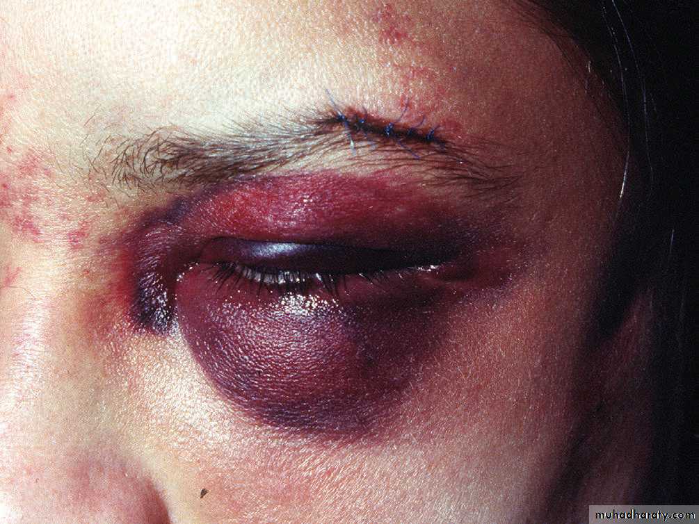 Wounds