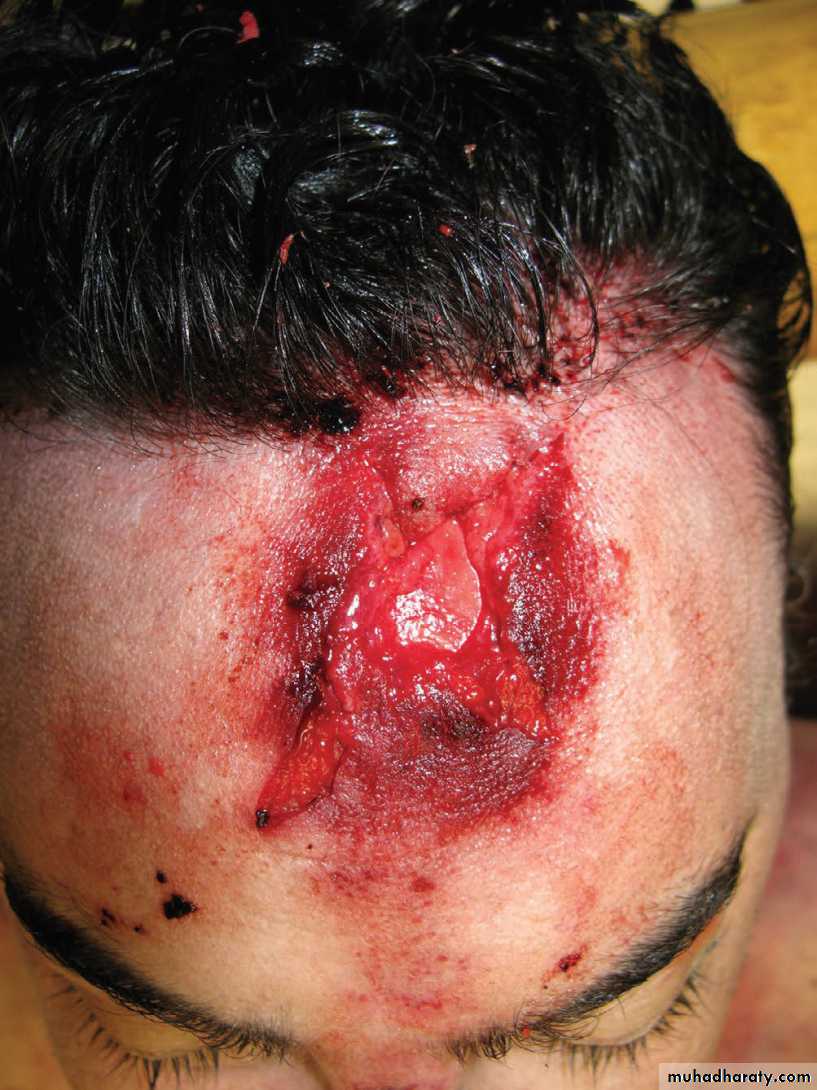 Wounds