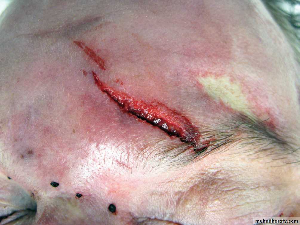 Wounds