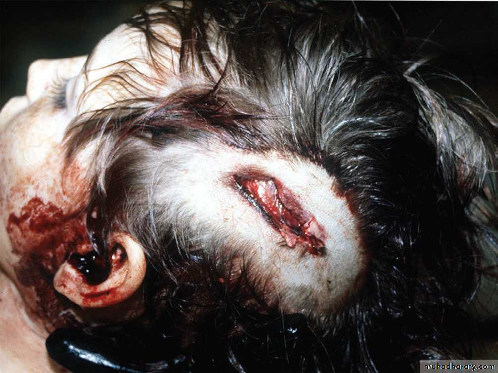 Wounds