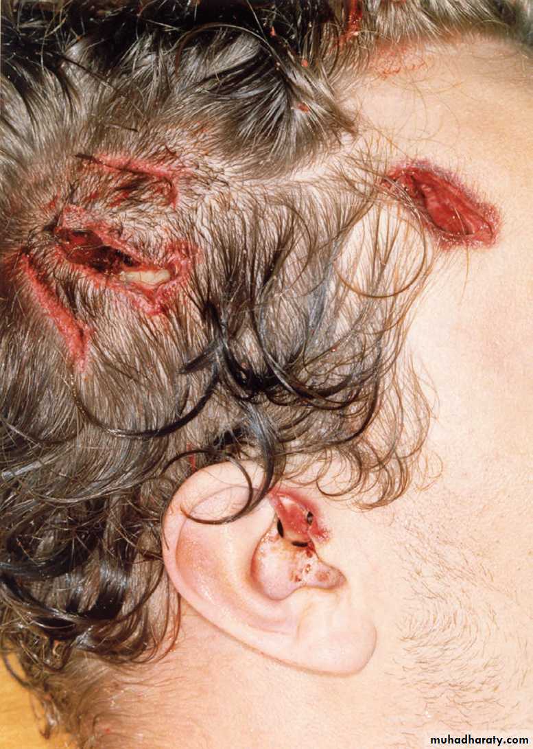 Wounds