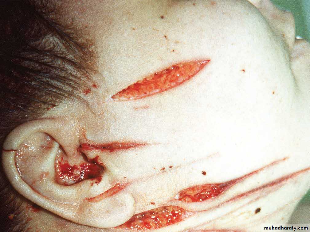 Wounds