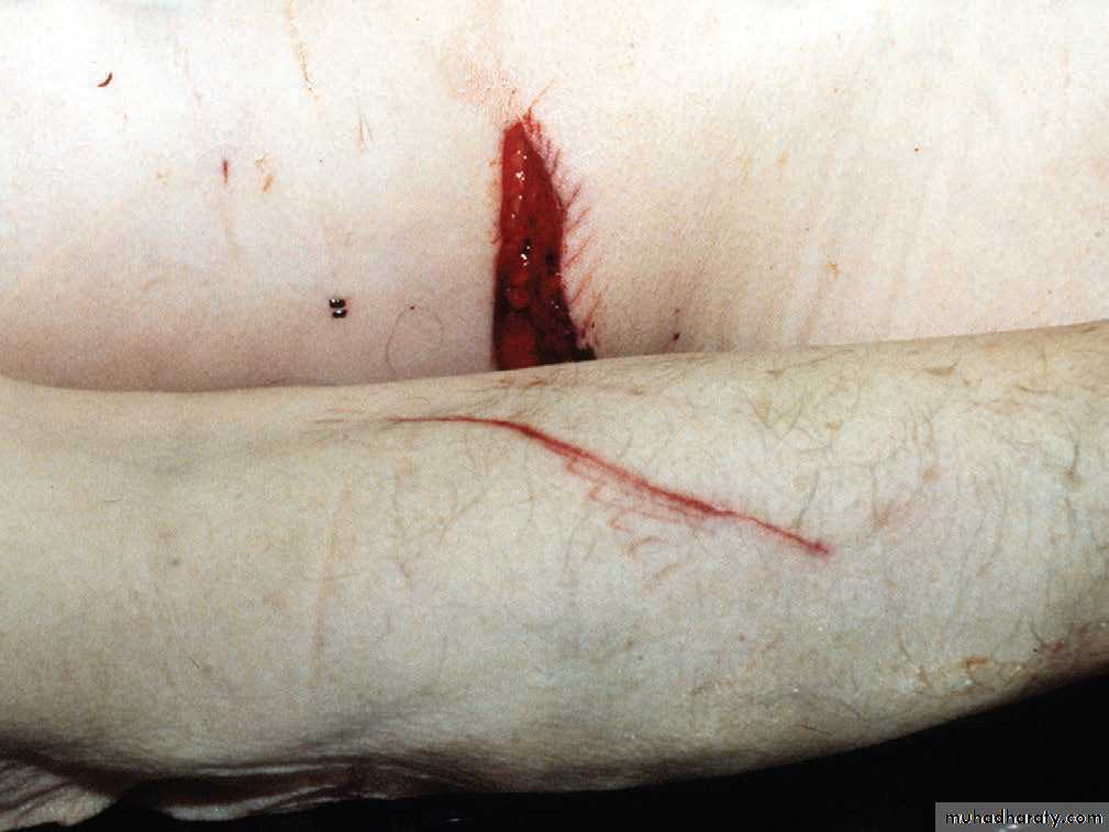 Wounds