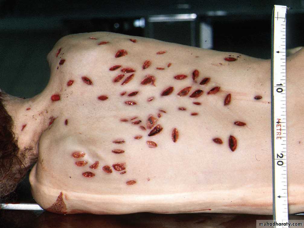 Wounds