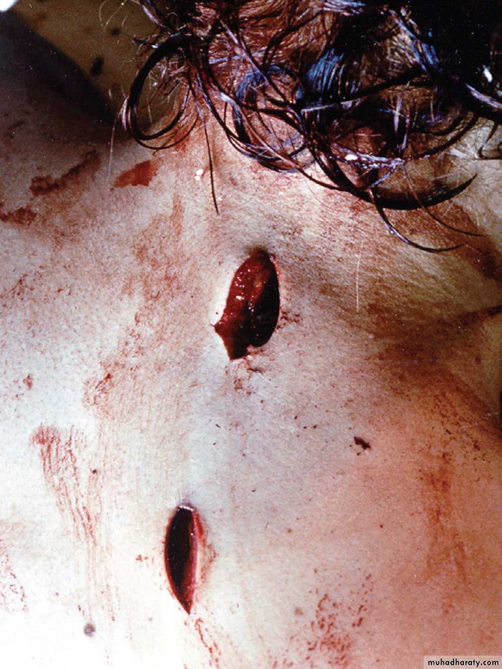 Wounds