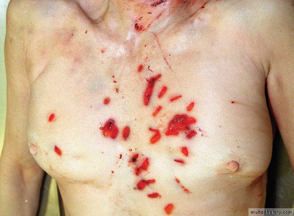 Wounds