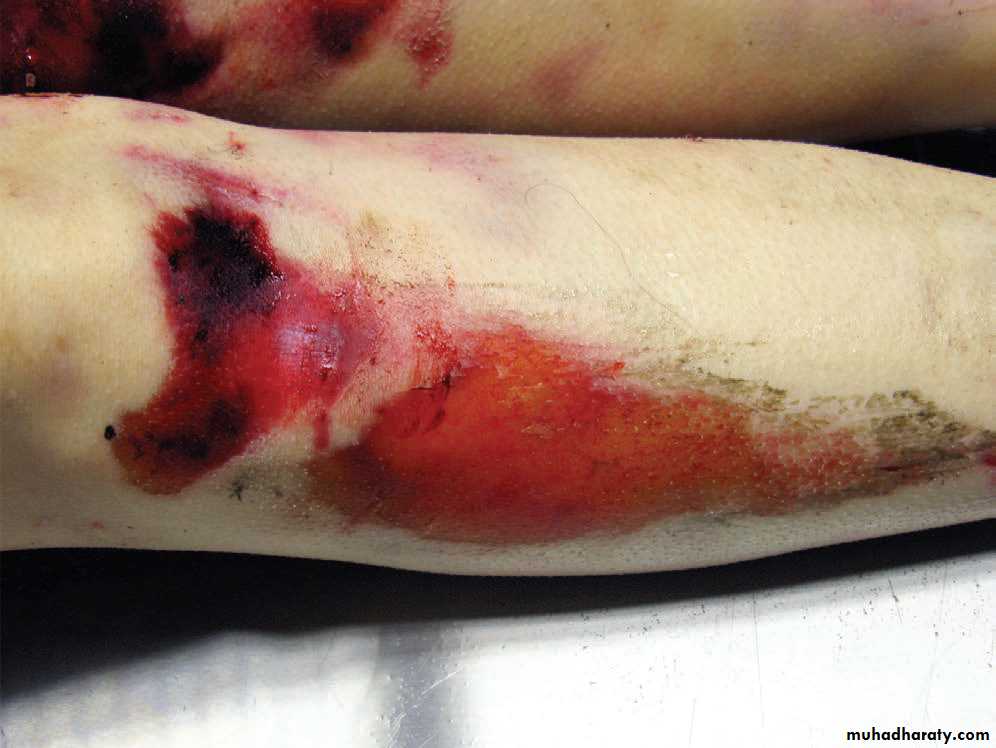 Wounds