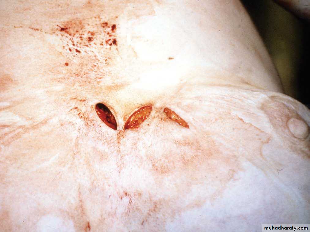 Wounds