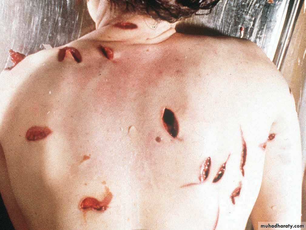 Wounds