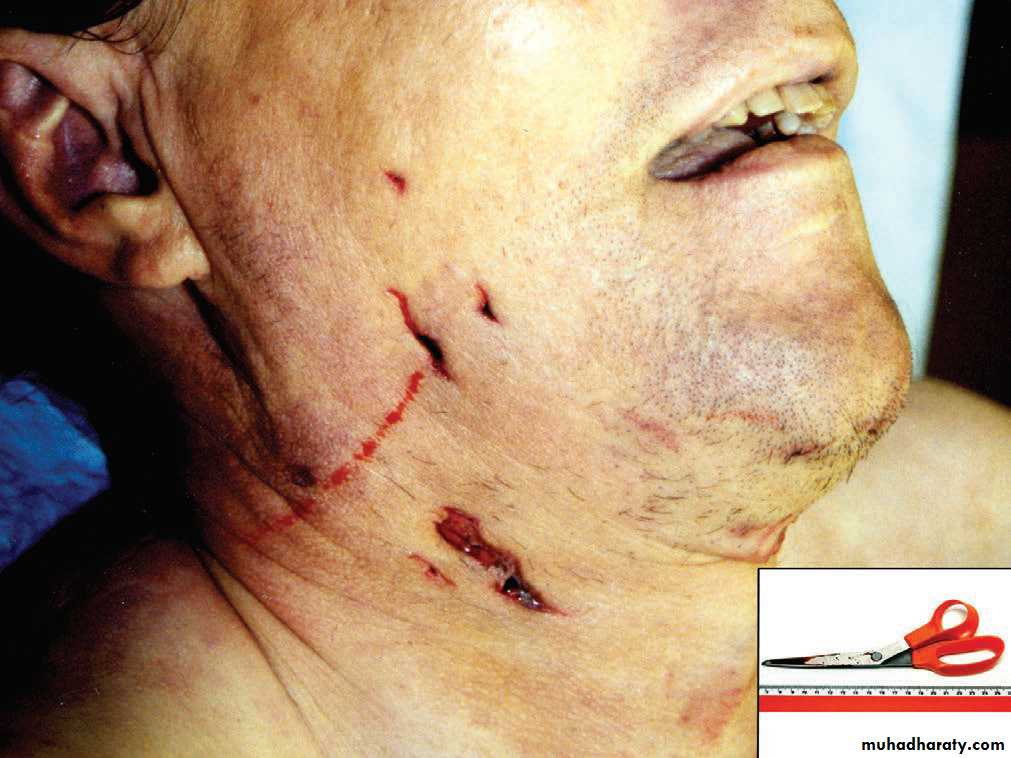 Wounds